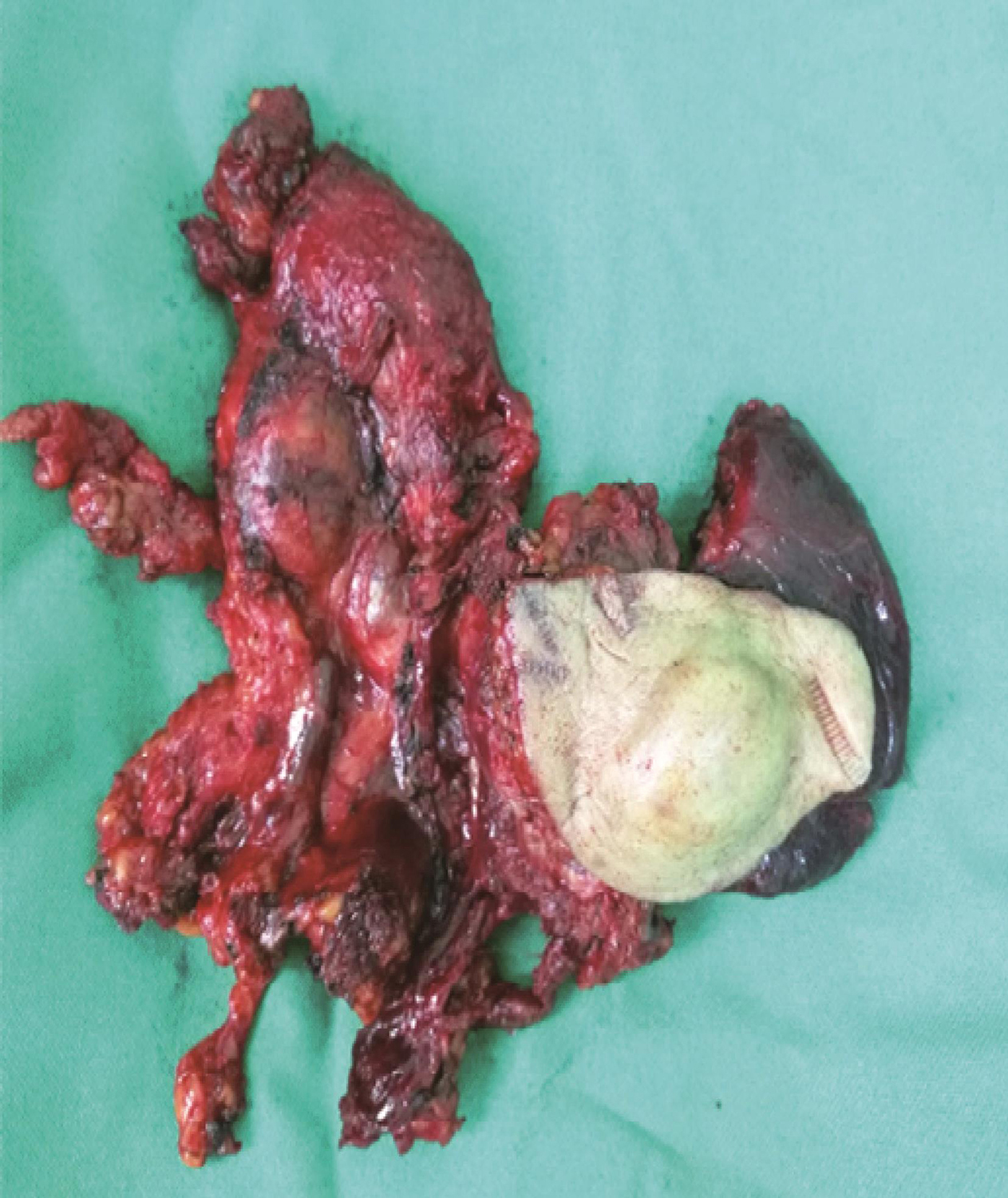 /uploads/image/2025-05-26/162938468图10 手术标本.jpg 图10 手术标本